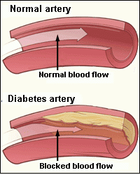 Heart Disease