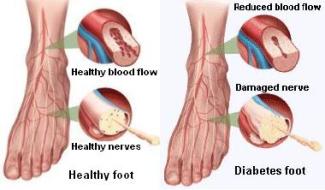Diabetic Foot Care