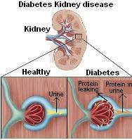 Diabetes Kidney Disease