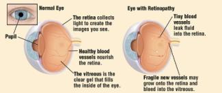 Diabetes Retinopathy