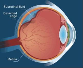 Retinal Detachment