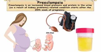 Preeclampsia